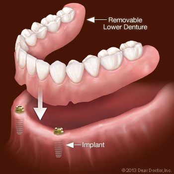 One Tooth Dentures La Coste TX 78039